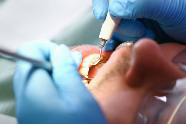 Best Emergency Root Canal Treatment in Aumsville, OR
